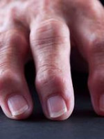 Osteoarthritis of the hand