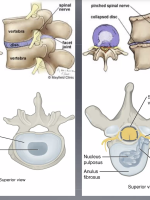 spinal claudication