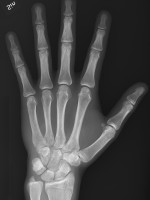 X-ray of normal hand